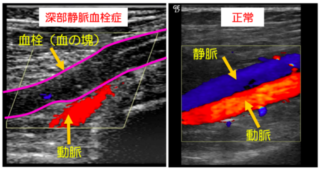 脳底静脈血栓症の原因